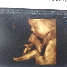 Beautiful baby girl sucking on her thumb on ultrasound.