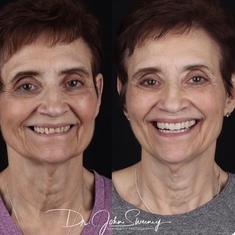 Joyce before and after having her teeth bonded, taken at different times by dentist 2019 -2020