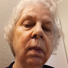 I had surgery to remove skin cancer from my nose.