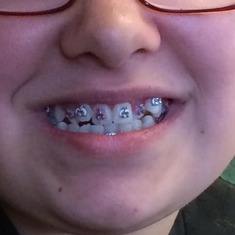 Sabrah with braces